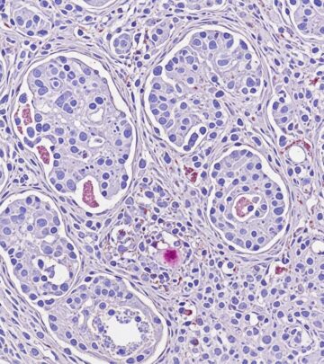 Detailed pathology of hidradenocarcinoma, a rare aggressive sweat gland carcinoma with diagnostic challenges and metastasis risks.