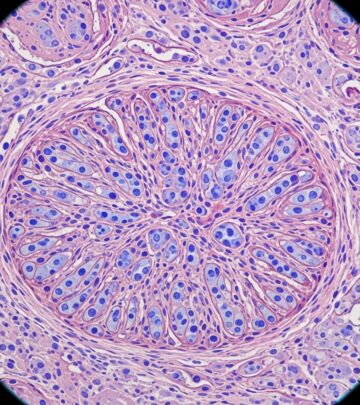 Comprehensive guide to IDF pathology, diagnosis, and management in infants and children.